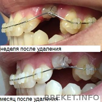 прогресс левого клыка за месяц.jpg