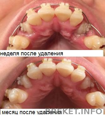 прогресс клыков за месяц.jpg