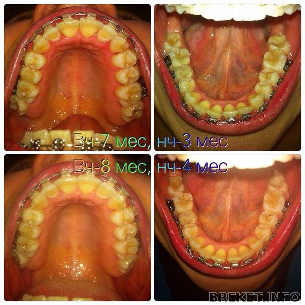 челюсти 8мес вч, 4 мес нч