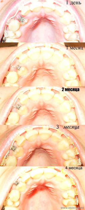 за 4 месяца зубик почти вытянули)