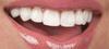 unlock-the-power-of-your-perfect-smile-with-porcelain-veneers.jpg