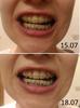 2018_07_18_front_do_i_posle_perekleyki.jpg