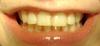 зубки