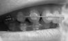 уровень основания клыка по отношению к зубному ряду
