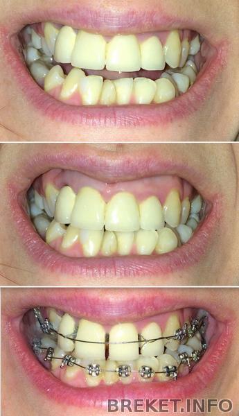 до установки и через 2 недели