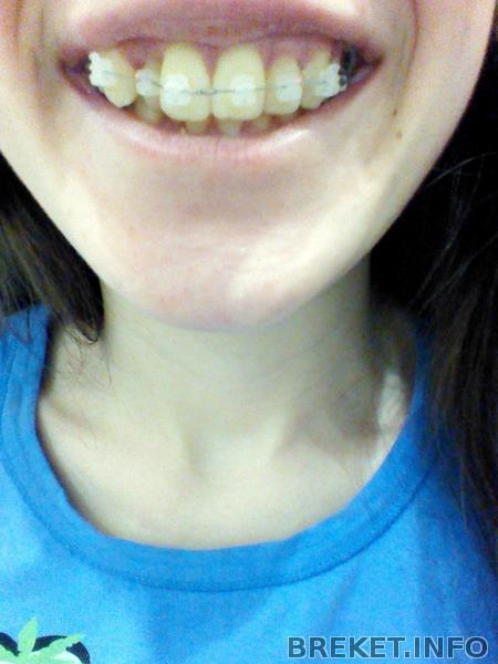 1 день в брекетах