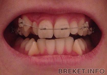 Второй день в брекетах.jpg