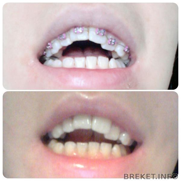 Открытый прикус