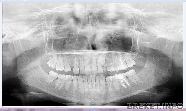 ортопантомограмма 