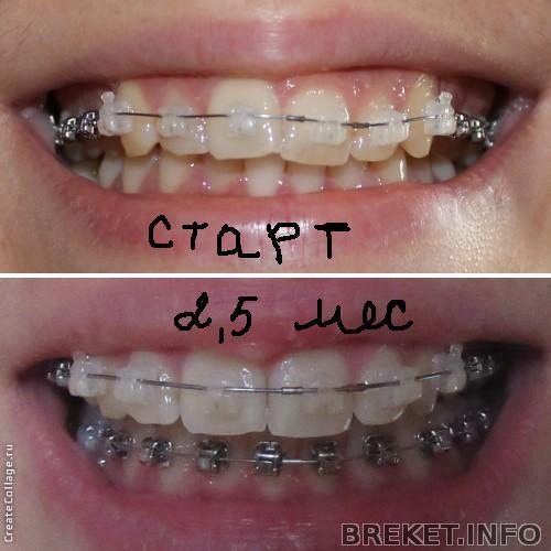 Результат 2,5 месяца