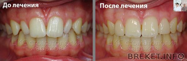 korrekciya_formy_zubov.jpg