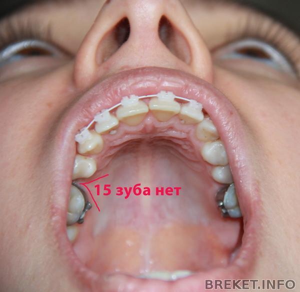 15 зуба нет.jpg