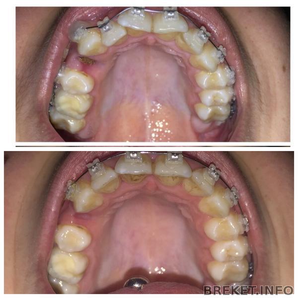 Брекеты , первые результаты 