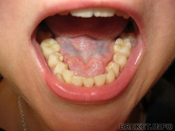 Зубы до брекетов