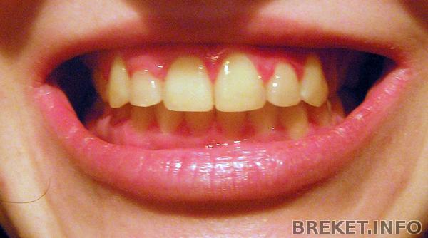 зубья