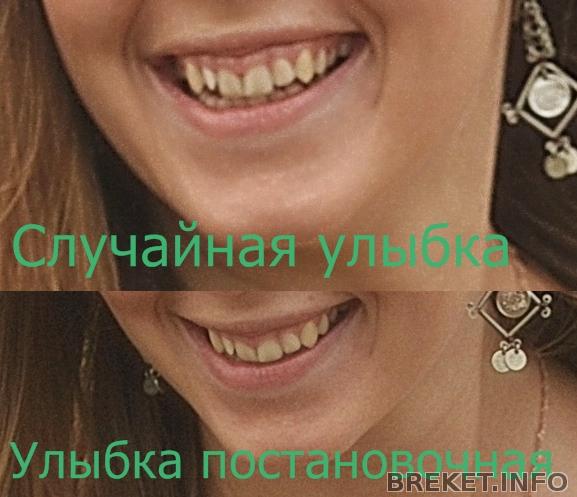 десневая улыбка