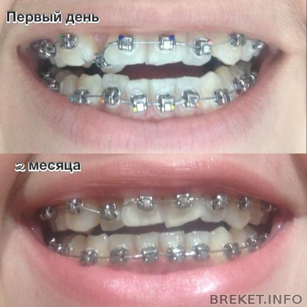 "Улыбочка" через 2 месяца