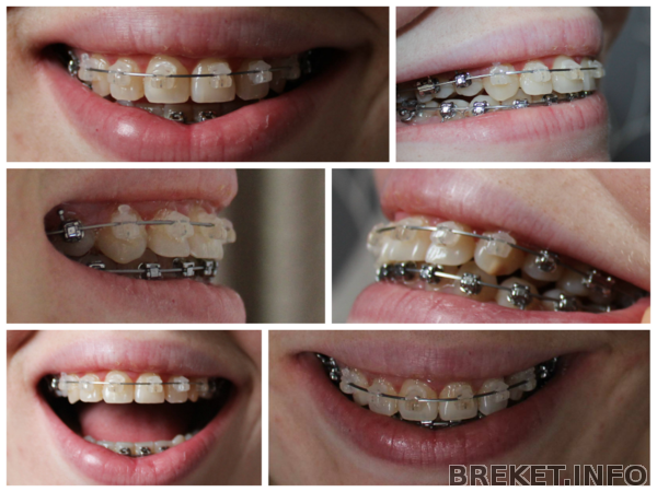 Зубы 1 год