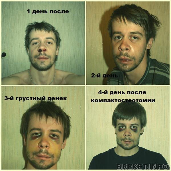 компактостеотомия