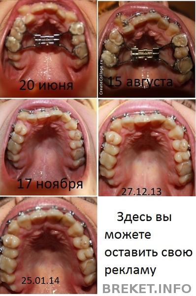 kompaktosteotomiya_brekety_iyun_-_avgust-noyabr-dekabr.jpg