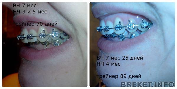 7 мес ВЧ и 3 мес 5 дней НЧ