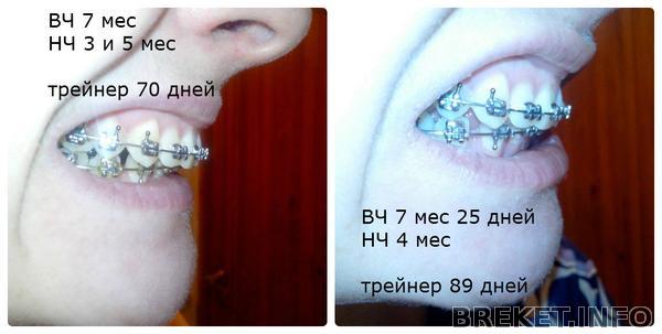 7 мес ВЧ и 4 мес НЧ