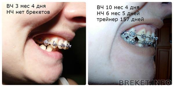 3_i_4_vch_-_10m_mes_vch.jpg