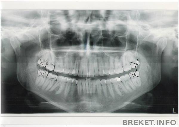 snimok.jpg снимок до удаления восьмерок