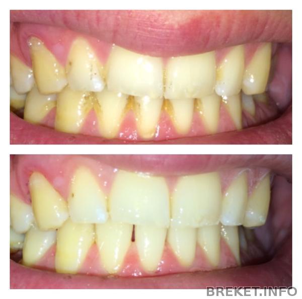 чистка зубов