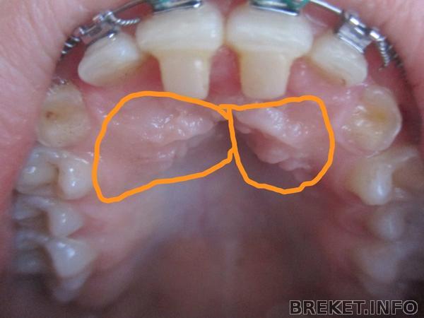 Ретинированные клыки