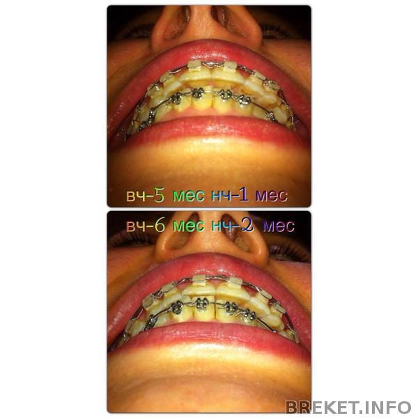 5-6 месяцев прикус 5-6 месяцев прикус