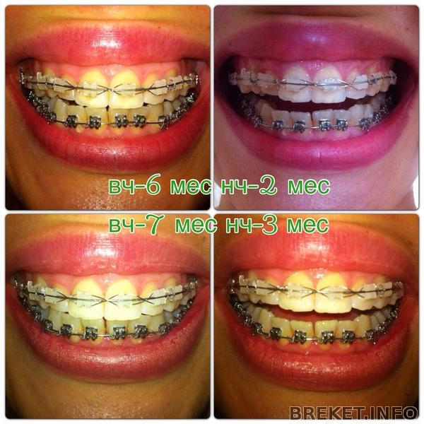 анфас вч-7, нч-3 анфас вч-7, нч-3