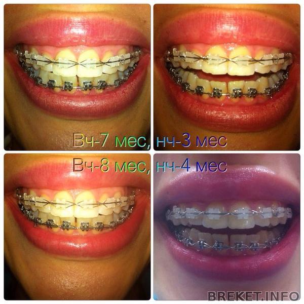 анфас 8 мес вч, 4 мес нч