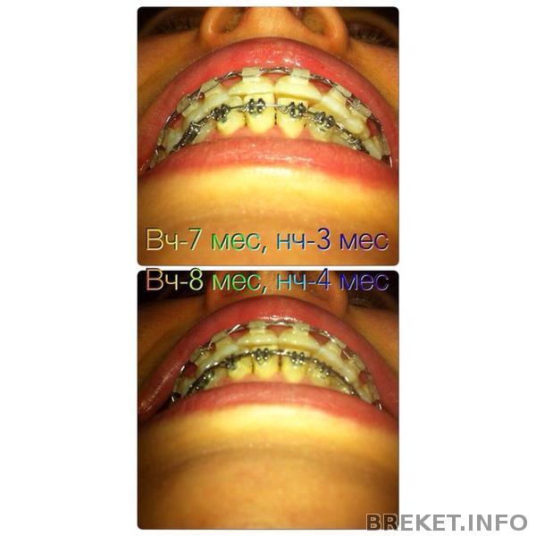 щель 8 мес вч, 4 мес нч