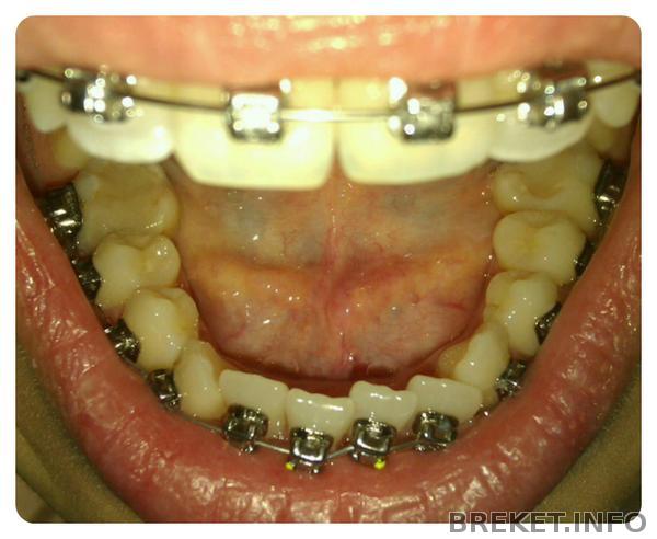 Низ в день установки