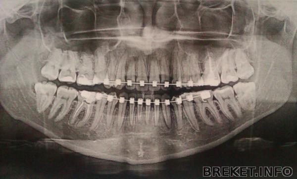 Зубья после 18 месяцев брекетной атаки