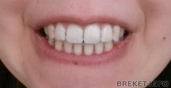 После снятия