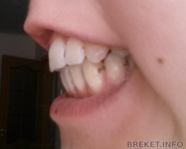 Спустя 1 день после снятия 