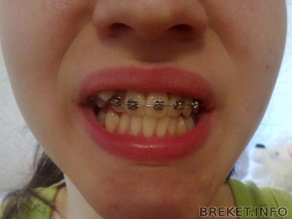 Мои кривульки, брекетам 1 неделя.jpg