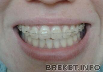 3 месяца после установки