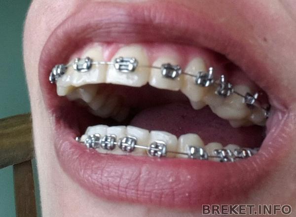 наклеили брекет на 4 слева.jpg