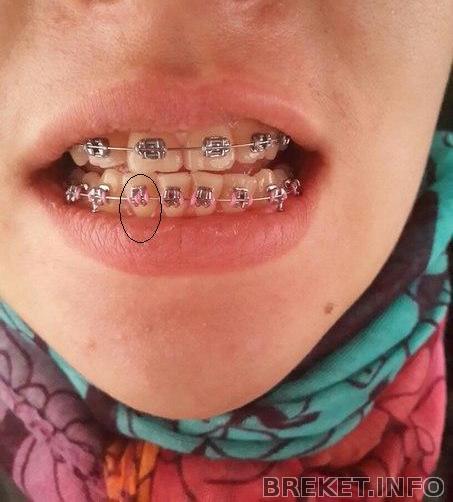 Что это с резиночкой на НЧ 2 зуб.jpg