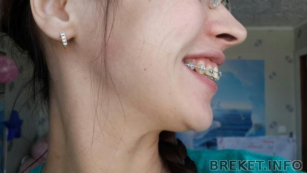 передние единички выпирают.jpg