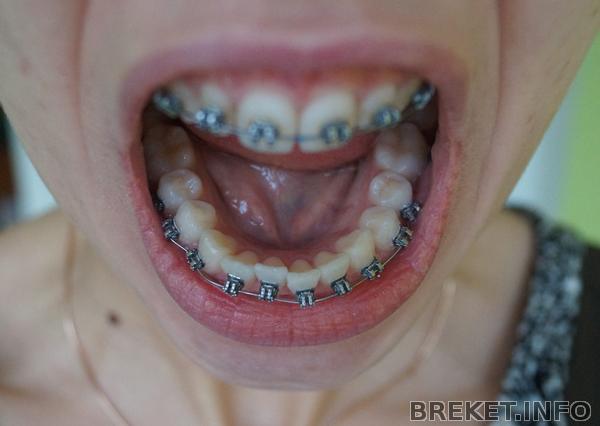 Дуга НЧ. День установки