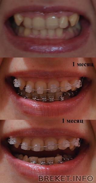 Зубам 1 месяц.jpg