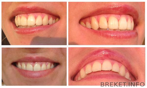 1_chas_posle_snyatiya_.jpg 1_chas_posle_snyatiya_.jpg