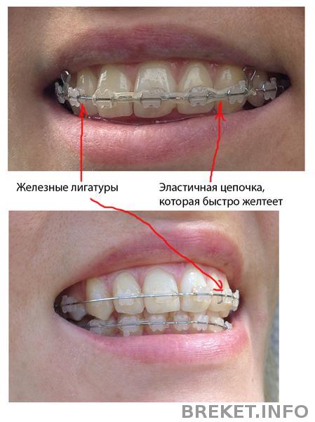 zheleznye_ligatury.jpg zheleznye_ligatury.jpg