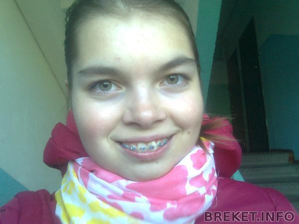 уже в брекетах уже в брекетах