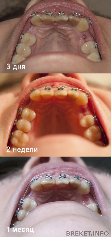 Поставить брекеты только на нижние зубы Поставить брекеты только на нижние зубы