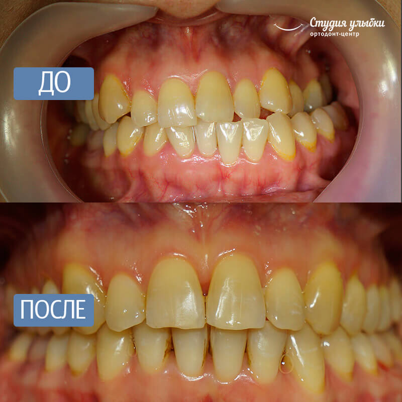 После установки брекетов стоматит
